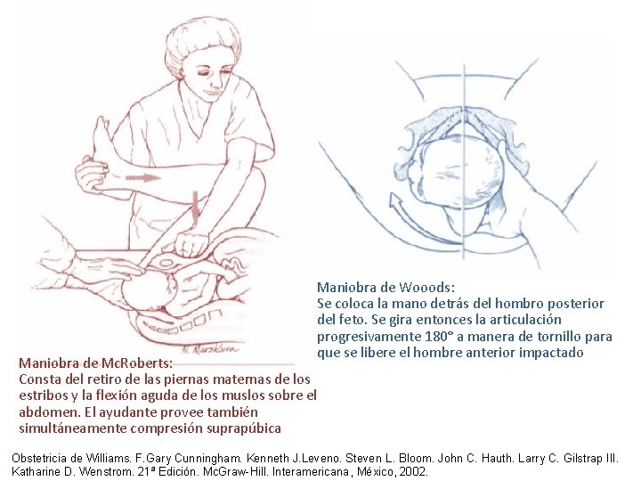 Maniobra de Wooods: Se coloca la mano detrás del hombro posterior del feto. Se Maniobra de Wooods: Se coloca la mano detrás del hombro posterior del feto. Se