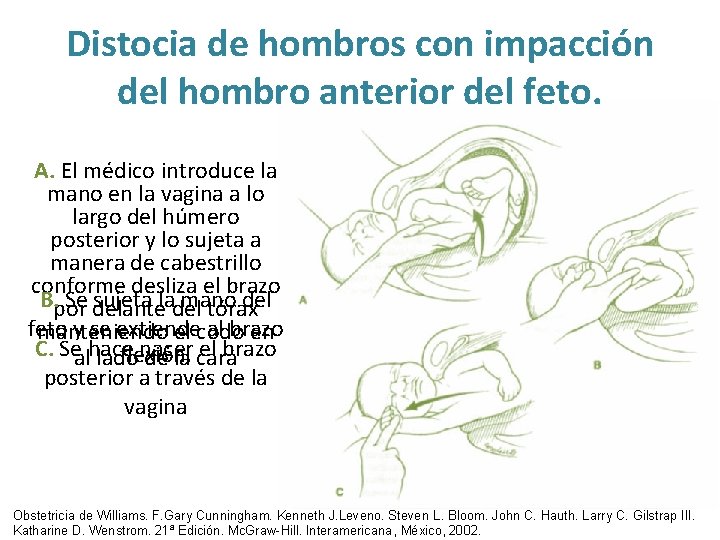Distocia de hombros con impacción del hombro anterior del feto. A. El médico introduce Distocia de hombros con impacción del hombro anterior del feto. A. El médico introduce