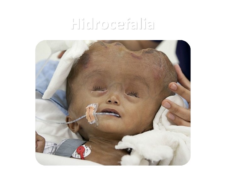 Hidrocefalia Hidrocefalia