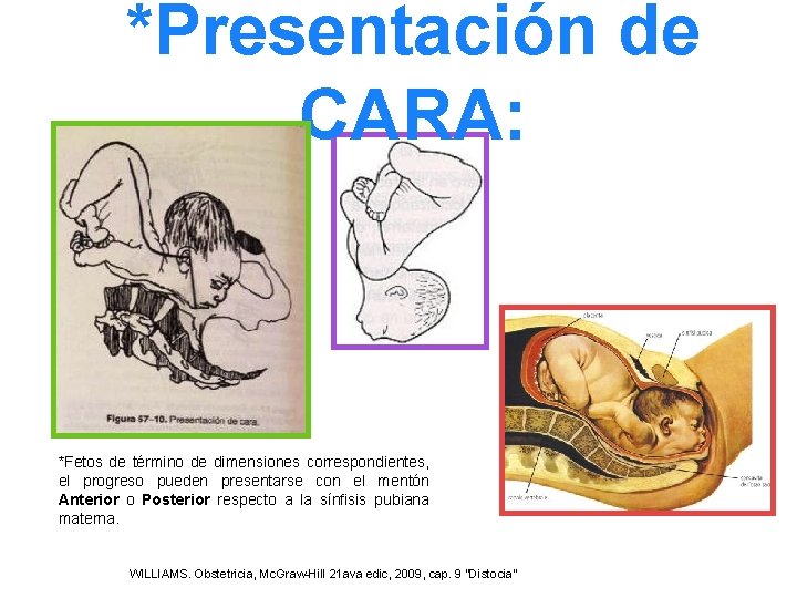 *Presentación de CARA: *Fetos de término de dimensiones correspondientes, el progreso pueden presentarse con *Presentación de CARA: *Fetos de término de dimensiones correspondientes, el progreso pueden presentarse con