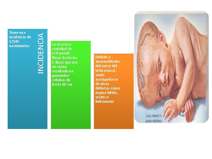 INCIDENCIA Tiene una incidencia de 1/500 nacimientos La excesiva cantidad de LCR puede llegar INCIDENCIA Tiene una incidencia de 1/500 nacimientos La excesiva cantidad de LCR puede llegar