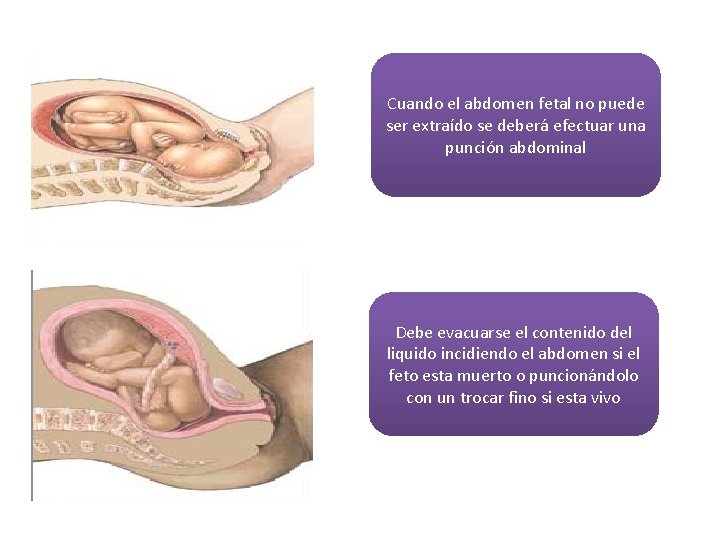 Cuando el abdomen fetal no puede ser extraído se deberá efectuar una punción abdominal Cuando el abdomen fetal no puede ser extraído se deberá efectuar una punción abdominal