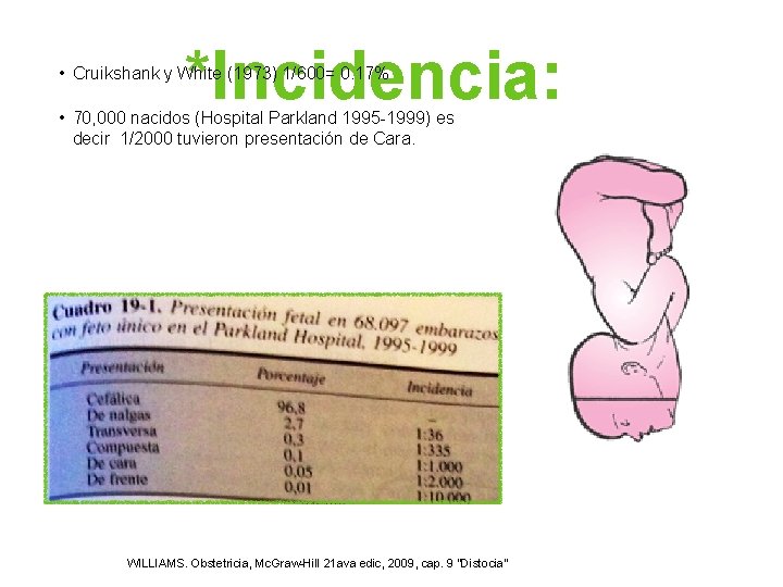 *Incidencia: • Cruikshank y White (1973) 1/600= 0. 17% • 70, 000 nacidos (Hospital *Incidencia: • Cruikshank y White (1973) 1/600= 0. 17% • 70, 000 nacidos (Hospital