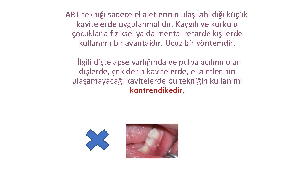  ART tekniği sadece el aletlerinin ulaşılabildiği küçük kavitelerde uygulanmalıdır. Kaygılı ve korkulu çocuklarla