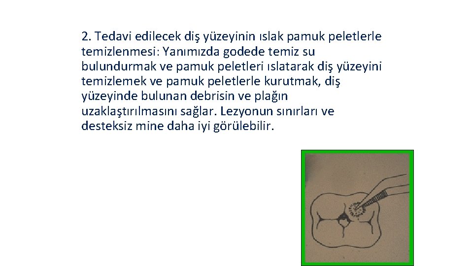  2. Tedavi edilecek diş yüzeyinin ıslak pamuk peletlerle temizlenmesi: Yanımızda godede temiz su