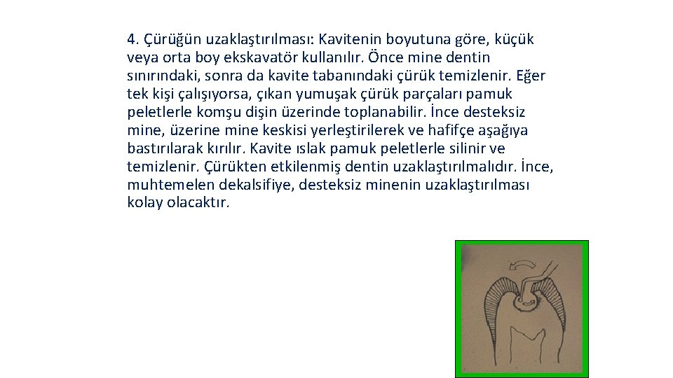 4. Çürüğün uzaklaştırılması: Kavitenin boyutuna göre, küçük veya orta boy ekskavatör kullanılır. Önce mine