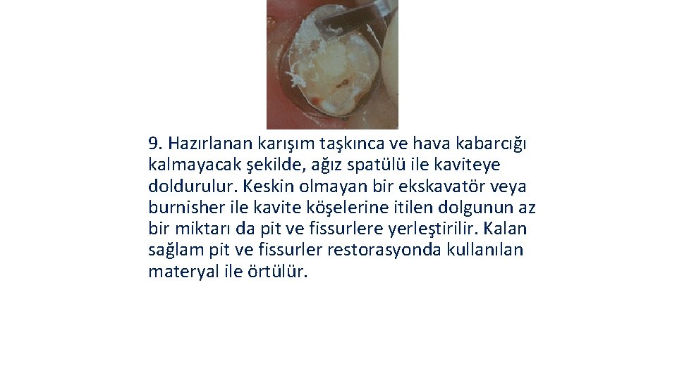 9. Hazırlanan karışım taşkınca ve hava kabarcığı kalmayacak şekilde, ağız spatülü ile kaviteye doldurulur.