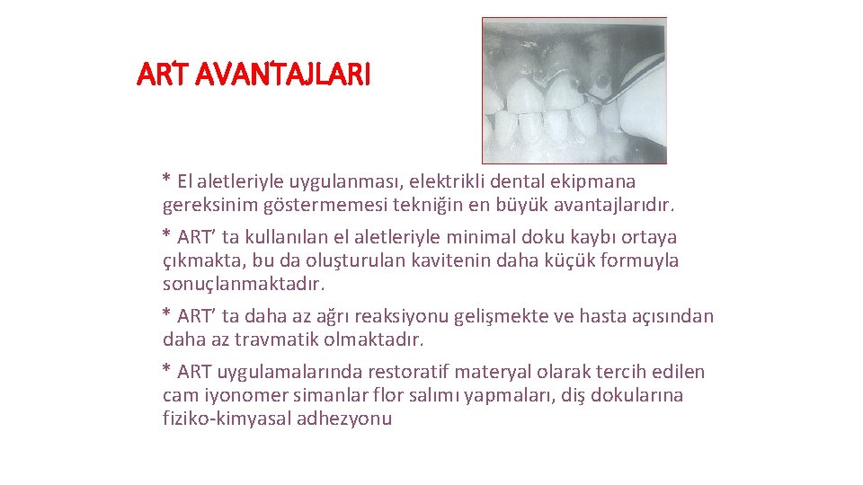 ART AVANTAJLARI * El aletleriyle uygulanması, elektrikli dental ekipmana gereksinim göstermemesi tekniğin en büyük