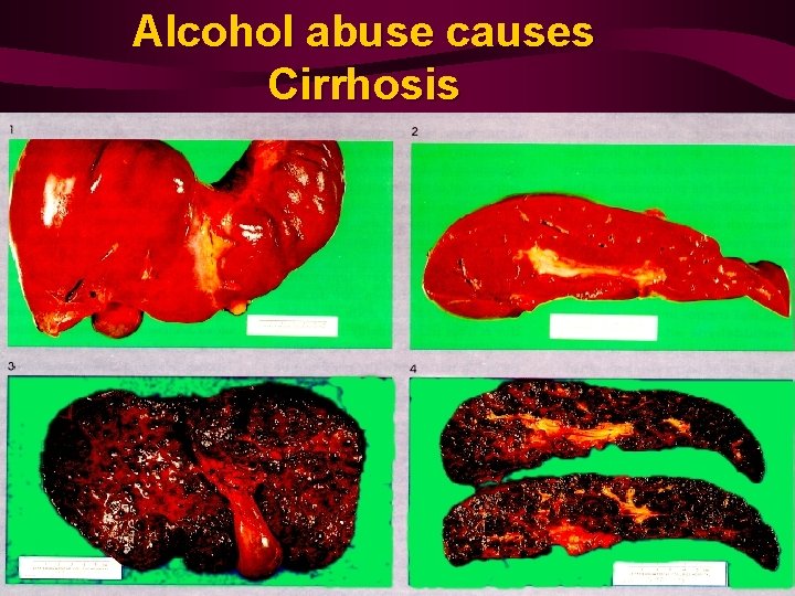 Alcohol abuse causes Cirrhosis 