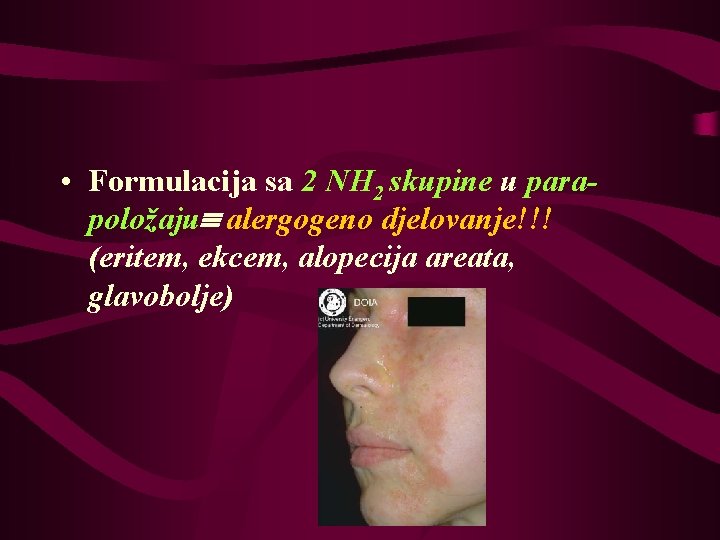  • Formulacija sa 2 NH 2 skupine u parapoložaju alergogeno djelovanje!!! (eritem, ekcem,