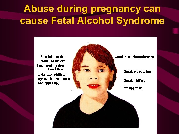 Abuse during pregnancy can cause Fetal Alcohol Syndrome Skin folds at the corner of