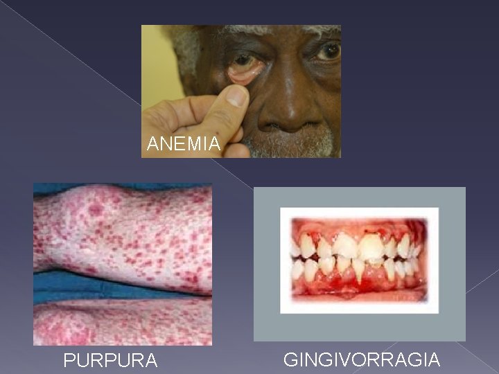 ANEMIA PURPURA GINGIVORRAGIA 