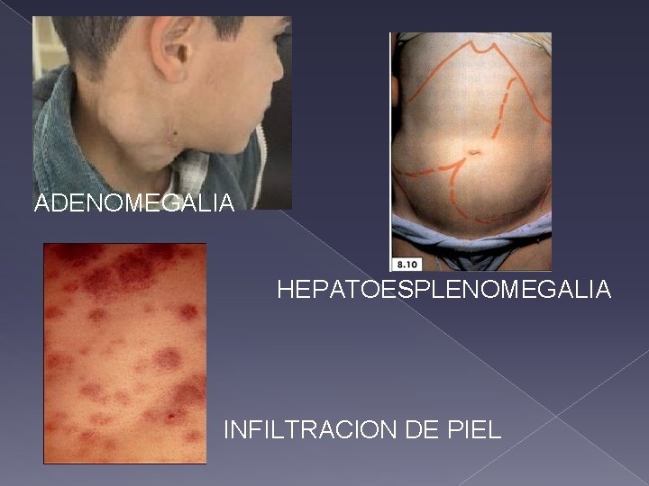 ADENOMEGALIA HEPATOESPLENOMEGALIA INFILTRACION DE PIEL 