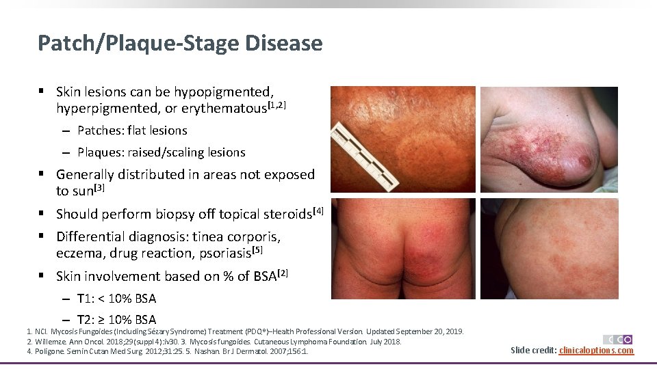 Patch/Plaque-Stage Disease § Skin lesions can be hypopigmented, hyperpigmented, or erythematous[1, 2] ‒ Patches: