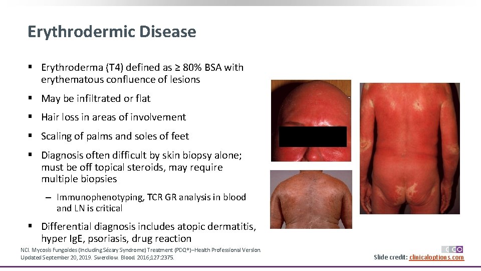 Erythrodermic Disease § Erythroderma (T 4) defined as ≥ 80% BSA with erythematous confluence