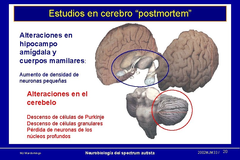 Estudios en cerebro “postmortem” Alteraciones en hipocampo amígdala y cuerpos mamilares: Aumento de densidad