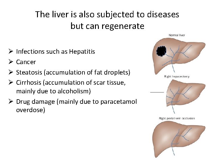 The liver is also subjected to diseases but can regenerate Infections such as Hepatitis