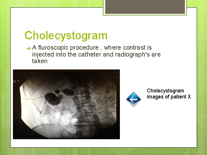 Cholecystogram A fluroscopic procedure , where contrast is injected into the catheter and radiograph's