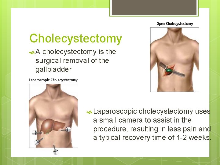 Cholecystectomy A cholecystectomy is the surgical removal of the gallbladder Laparoscopic cholecystectomy uses a Cholecystectomy A cholecystectomy is the surgical removal of the gallbladder Laparoscopic cholecystectomy uses a