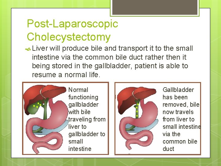 Post-Laparoscopic Cholecystectomy Liver will produce bile and transport it to the small intestine via Post-Laparoscopic Cholecystectomy Liver will produce bile and transport it to the small intestine via