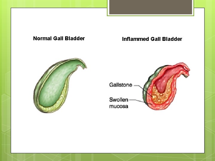 Normal Gall Bladder Inflammed Gall Bladder 