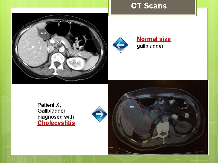 CT Scans Normal size gallbladder Patient X, Gallbladder diagnosed with Cholecystitis 