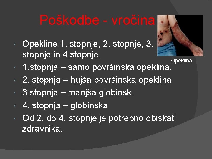 Poškodbe - vročina Opekline 1. stopnje, 2. stopnje, 3. stopnje in 4. stopnje. Opeklina