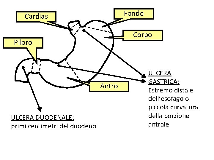 Fondo Cardias Corpo Piloro Antro ULCERA DUODENALE: primi centimetri del duodeno ULCERA GASTRICA: Estremo