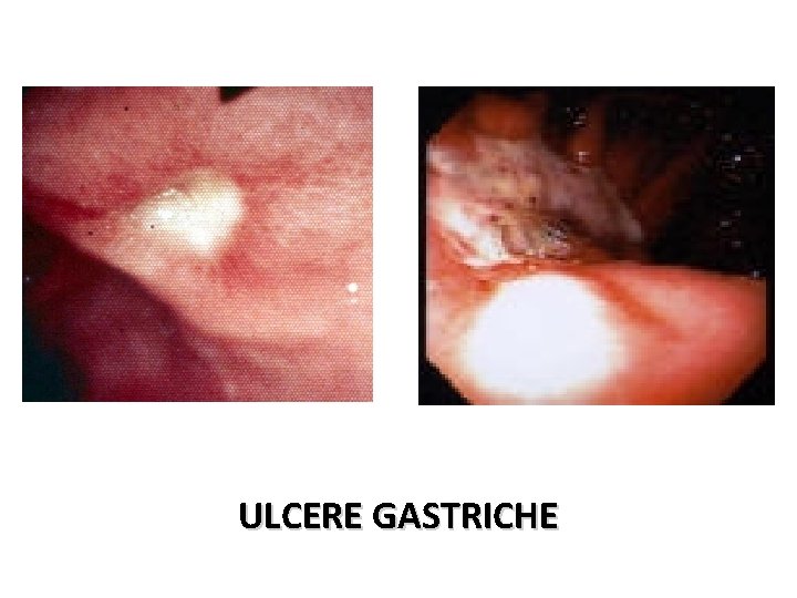 ULCERE GASTRICHE 