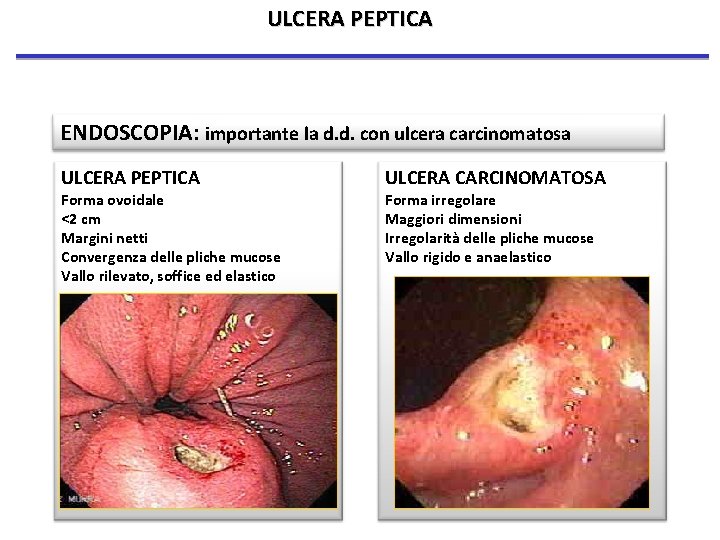 ULCERA PEPTICA ENDOSCOPIA: importante la d. d. con ulcera carcinomatosa ULCERA PEPTICA Forma ovoidale