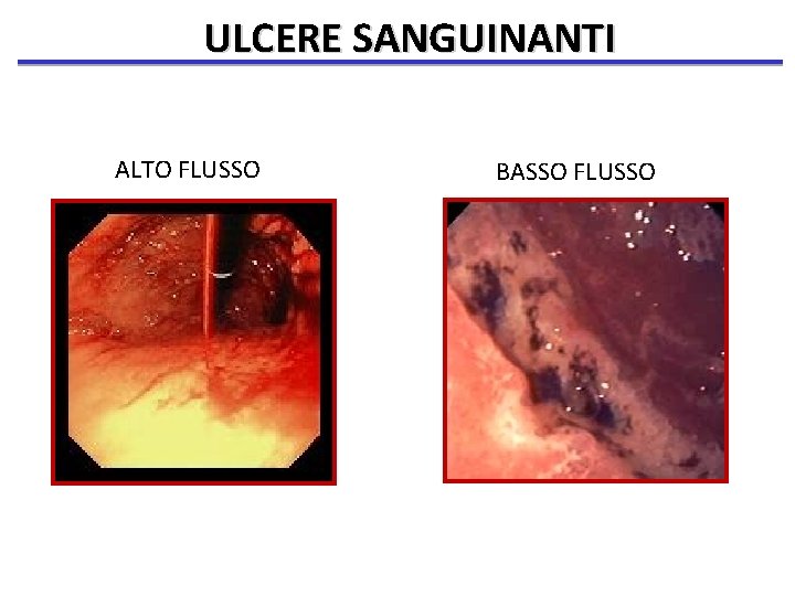 ULCERE SANGUINANTI ALTO FLUSSO BASSO FLUSSO 
