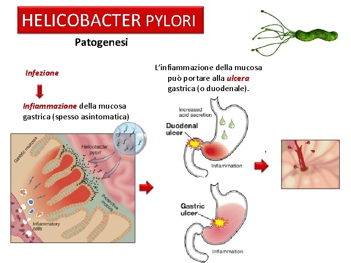 HELICOBACTER PYLORI Patogenesi Infezione Infiammazione della mucosa gastrica (spesso asintomatica) L’infiammazione della mucosa può