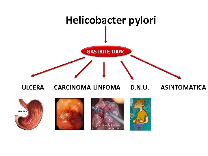 Helicobacter pylori GASTRITE 100% ULCERA CARCINOMA LINFOMA D. N. U. ASINTOMATICA 