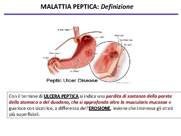 MALATTIA PEPTICA: Definizione Con il termine di ULCERA PEPTICA si indica una perdita di