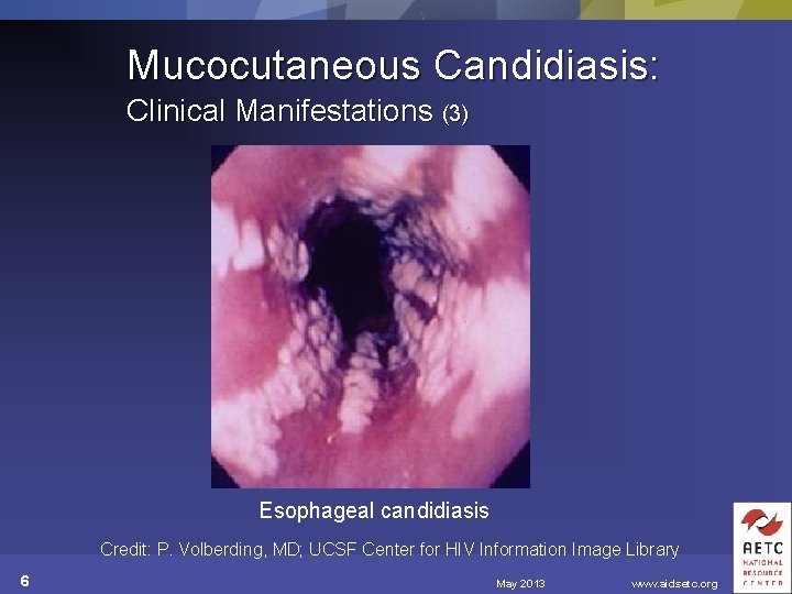 Mucocutaneous Candidiasis: Clinical Manifestations (3) Esophageal candidiasis Credit: P. Volberding, MD; UCSF Center for