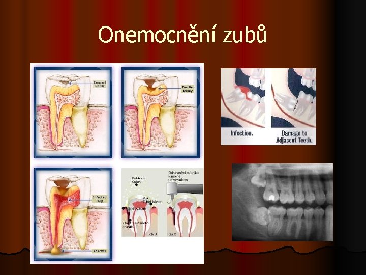 Onemocnění zubů 