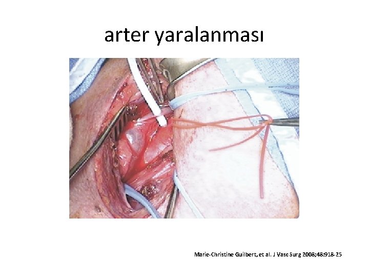 arter yaralanması Marie-Christine Guilbert, et al. J Vasc Surg 2008; 48: 918 -25 