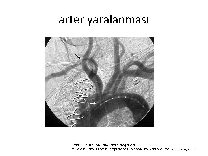 arter yaralanması Sadaf T. Bhutta; Evaluation and Management of Central Venous Access Complications Tech