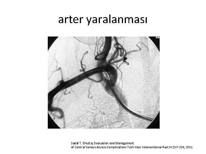 arter yaralanması Sadaf T. Bhutta; Evaluation and Management of Central Venous Access Complications Tech