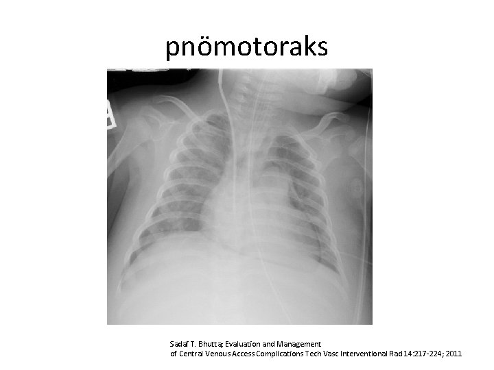 pnömotoraks Sadaf T. Bhutta; Evaluation and Management of Central Venous Access Complications Tech Vasc