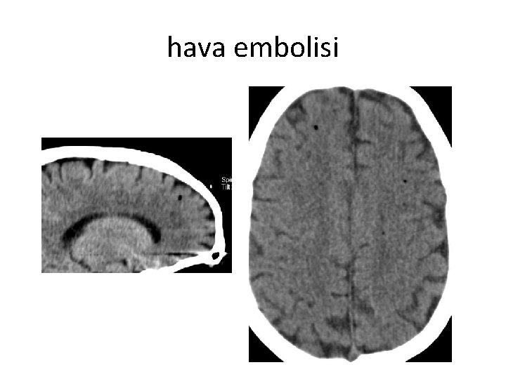 hava embolisi 