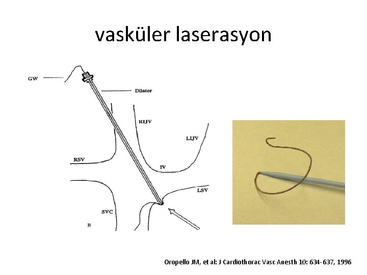 vasküler laserasyon Oropello JM, et al: J Cardiothorac Vasc Anesth 10: 634 -637, 1996