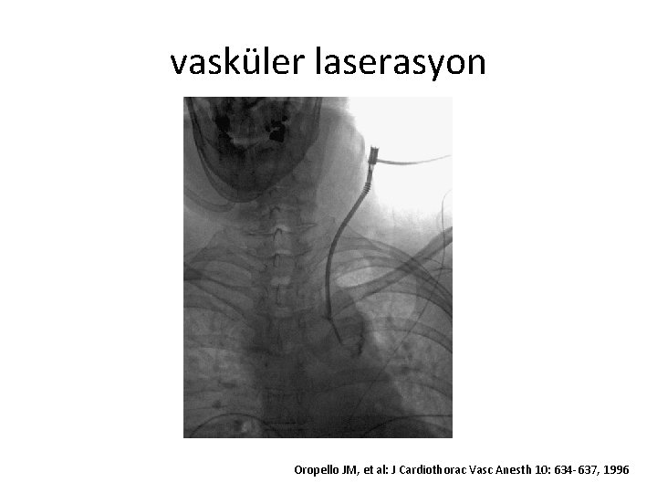 vasküler laserasyon Oropello JM, et al: J Cardiothorac Vasc Anesth 10: 634 -637, 1996