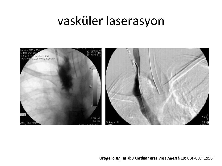 vasküler laserasyon Oropello JM, et al: J Cardiothorac Vasc Anesth 10: 634 -637, 1996