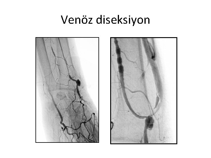 Venöz diseksiyon 