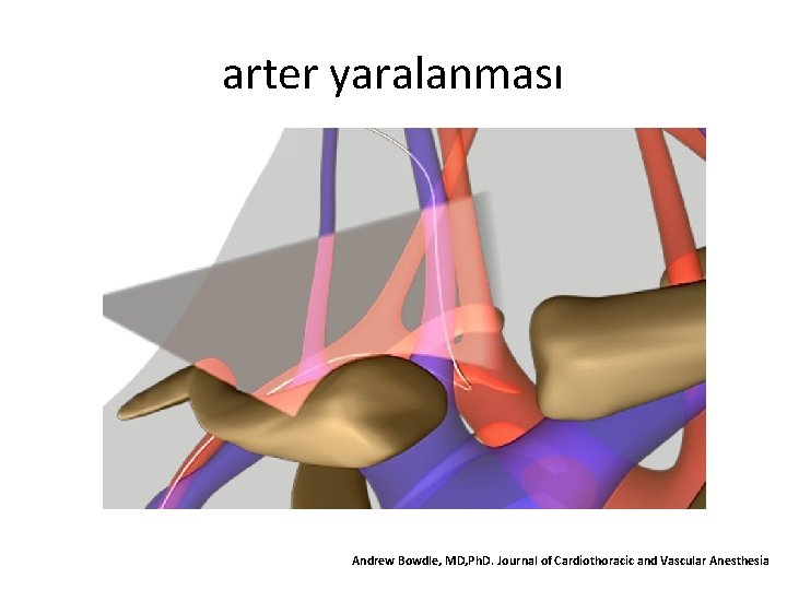 arter yaralanması Andrew Bowdle, MD, Ph. D. Journal of Cardiothoracic and Vascular Anesthesia 