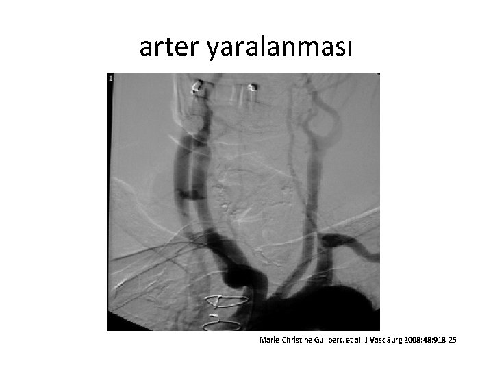 arter yaralanması Marie-Christine Guilbert, et al. J Vasc Surg 2008; 48: 918 -25 