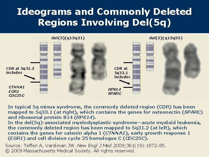 Ideograms and Commonly Deleted Regions Involving Del(5 q) del(5)(q 13 q 31) CDR at
