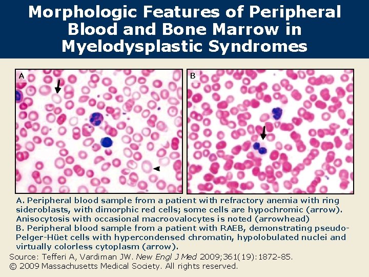 Morphologic Features of Peripheral Blood and Bone Marrow in Myelodysplastic Syndromes A B A.