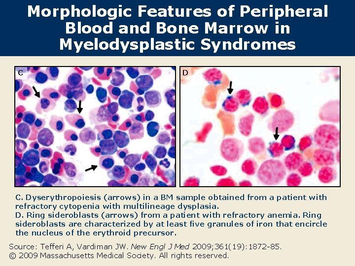 Morphologic Features of Peripheral Blood and Bone Marrow in Myelodysplastic Syndromes C D C.